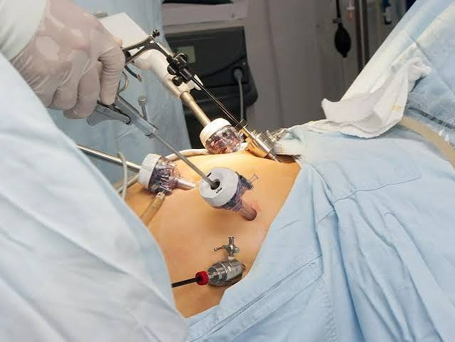 Laparoscopic Keyhole Surgery